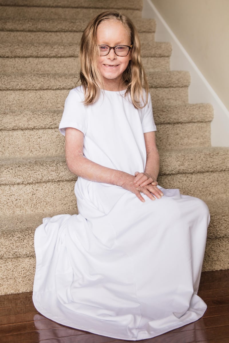 Hanna Barrott has a condition called lamellar ichthyosis. Despite life’s obstacles, Hanna has proven that her conditions do not define who she is and that her faith is much deeper than her skin.